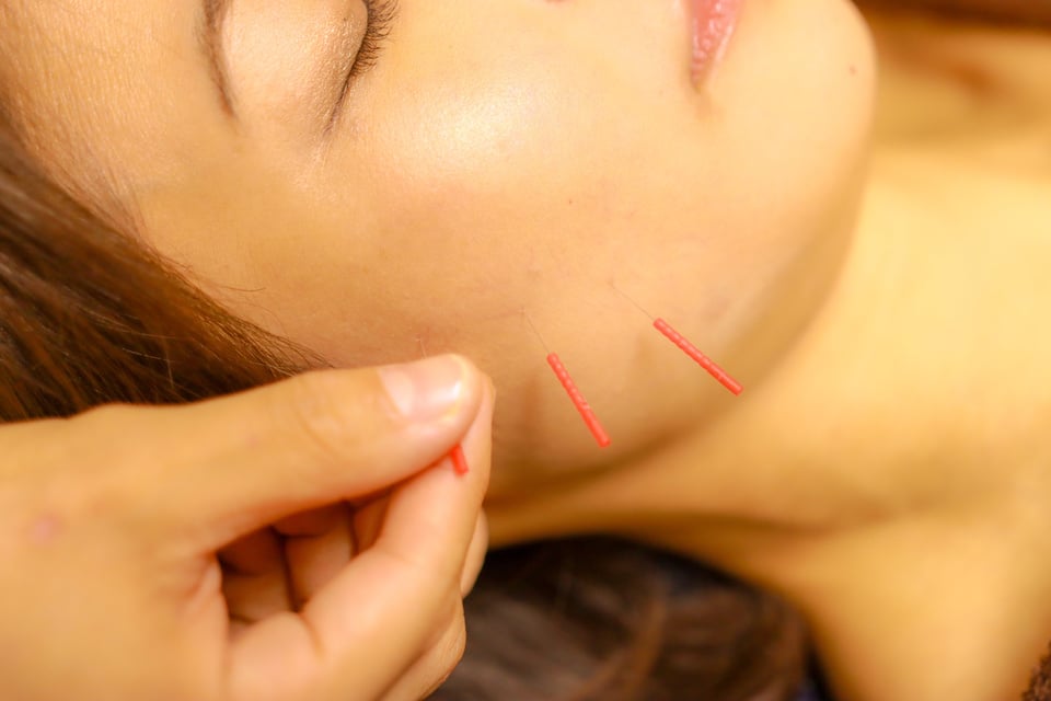 Cosmetic acupuncture in Asia