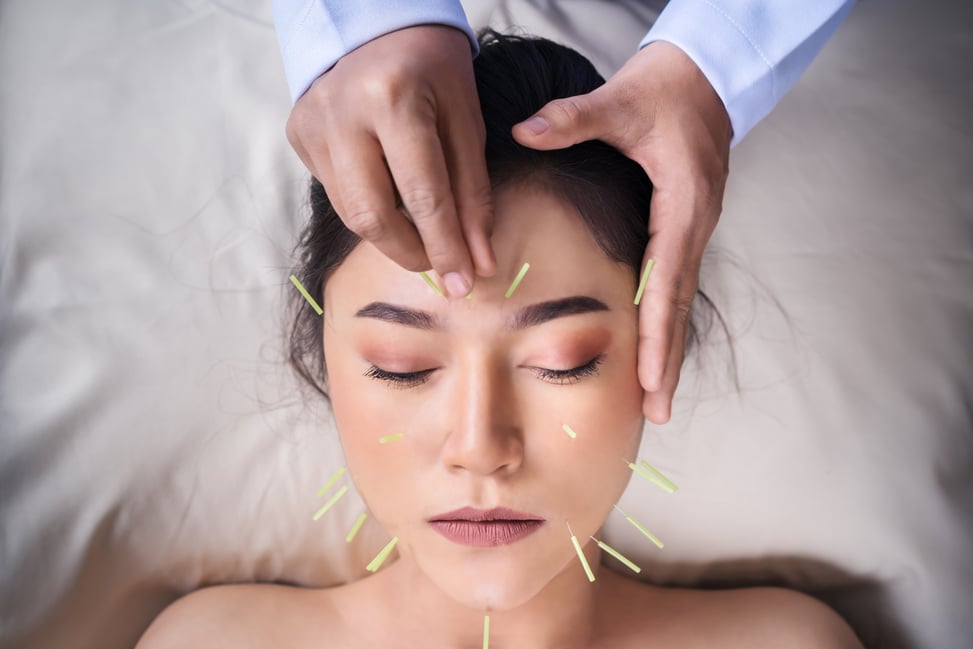 woman undergoing acupuncture treatment on face